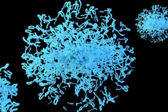 Neue Ergebnisse zu Parkinson im Frühstadium: Der Antikörper Prasinezumab könnte das Fortschreiten der Erkrankung bremsen